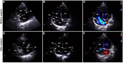 Case Report: unexpected cause of cyanosis in an infant after acute exposure to high altitude—severe tricuspid regurgitation secondary to tricuspid valve prolapse